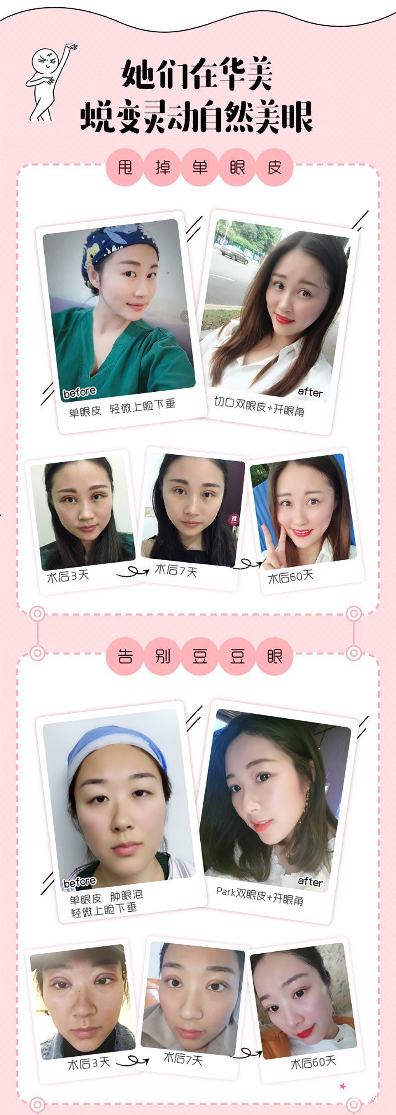 广州华美阮庆玲割双眼皮怎么样，有没有失败案例？