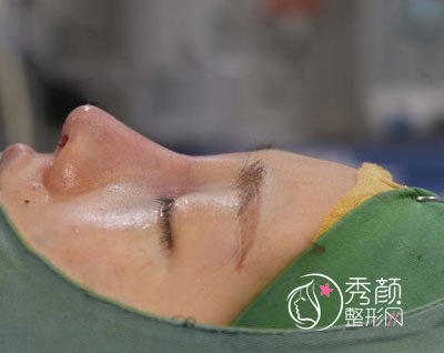 西安雁塔华旗唯美门诊部张沙沙隆鼻怎么样,有没有失败案例?