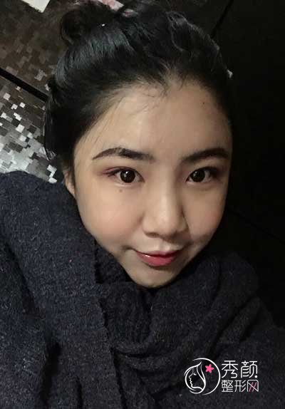 武汉韩辰余彩红脂肪填充怎么样，大概需要多少钱？