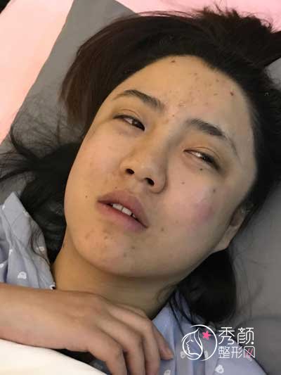 武汉韩辰余彩红脂肪填充怎么样，大概需要多少钱？