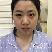 武汉韩辰余彩红脂肪填充怎么样，大概需要多少钱？