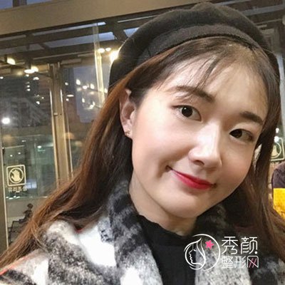 徐州华美李亚飞割双眼皮怎么样，有没有失败案例？
