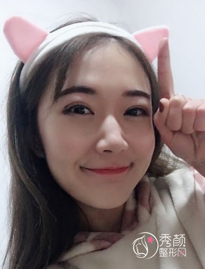 徐州华美李亚飞割双眼皮怎么样，有没有失败案例？