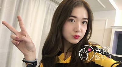 徐州华美李亚飞割双眼皮怎么样，有没有失败案例？