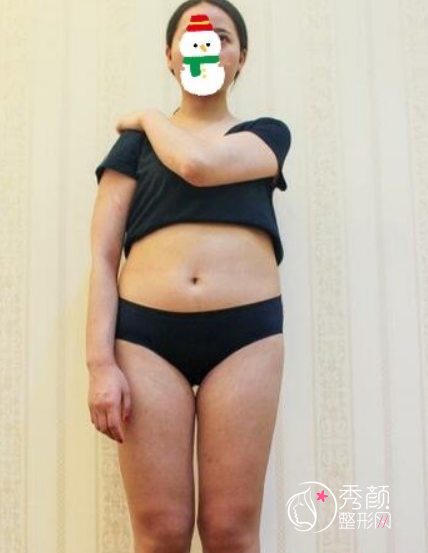 上海伊莱美李旭东吸脂怎么样，有没有失败案例？