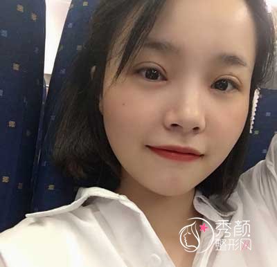 深圳蒳美迩黄海彬做双眼皮怎么样，有没有失败案例？