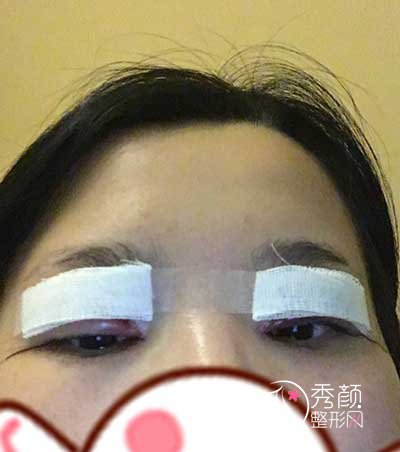 深圳蒳美迩黄海彬做双眼皮怎么样，有没有失败案例？