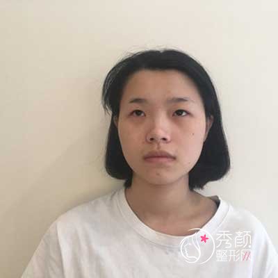 深圳蒳美迩黄海彬做双眼皮怎么样，有没有失败案例？