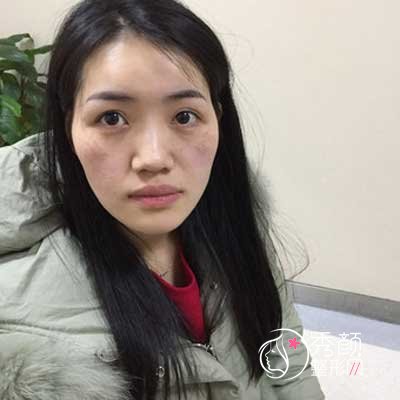 长沙华韩华美张涛脂肪填充怎么样,有没有失败案例？