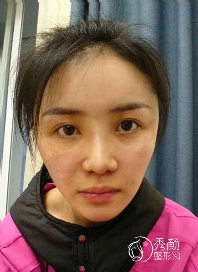 长沙华韩华美张涛脂肪填充怎么样,有没有失败案例？