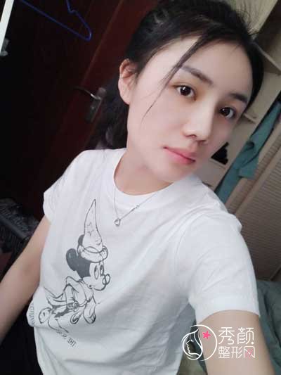 长沙华韩华美张涛脂肪填充怎么样,有没有失败案例？