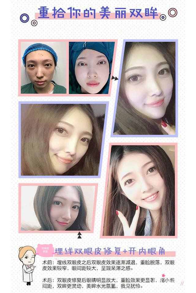 南京刘育凤双眼皮修复怎么样,有没有失败案例？