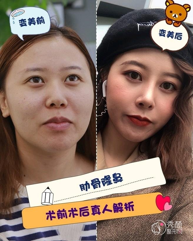 上海百达丽谭宇腾隆鼻怎么样|案例展示