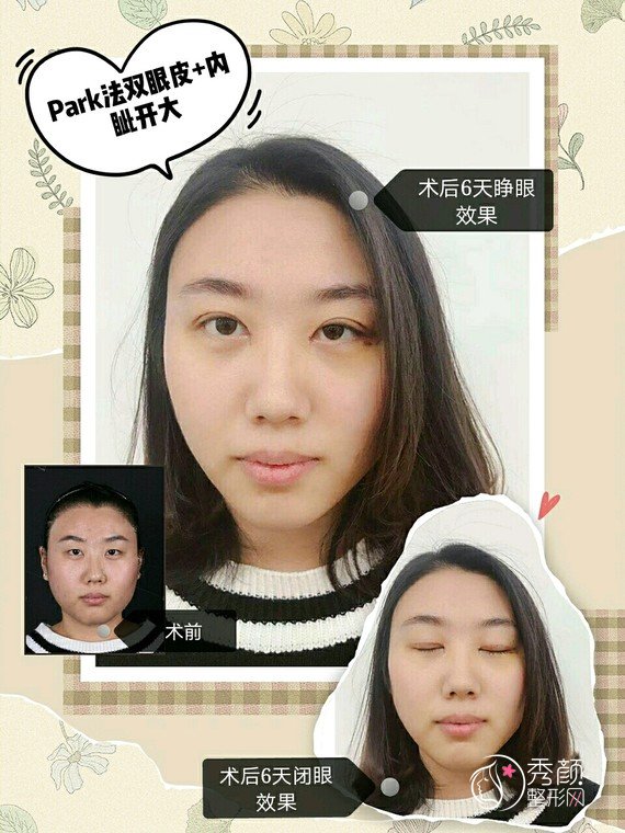 上海伯思立邵玉芳做双眼皮技术怎么样,有没有失败案例？