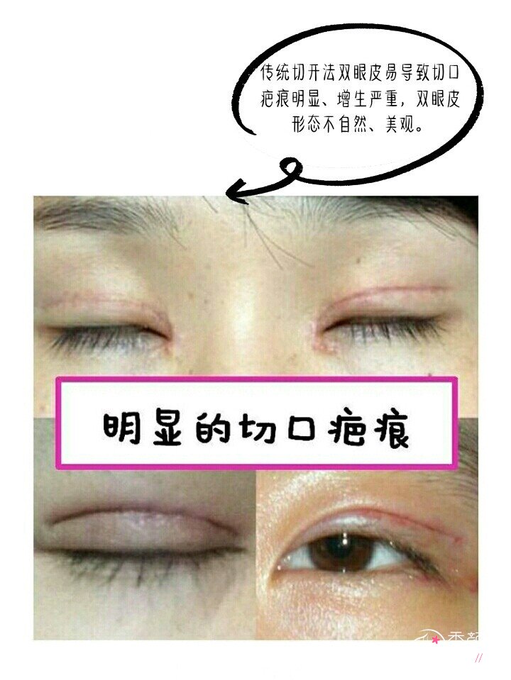 上海伯思立邵玉芳做双眼皮技术怎么样,有没有失败案例？