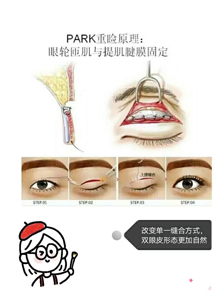 上海伯思立邵玉芳做双眼皮技术怎么样,有没有失败案例？