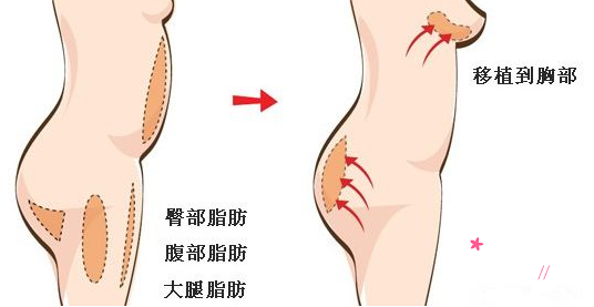 广州华美自体脂肪隆胸价格贵不贵