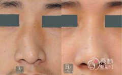 <b>武汉隆鼻哪个医院好，武汉隆鼻医院医生测评。</b>