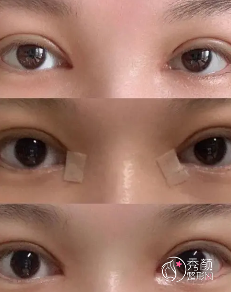 郑州割双眼皮哪个医院好？郑州双眼皮医院医生分析。