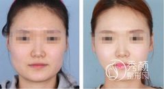 <b>注射注射瘦脸多少钱一针，有没有后遗症？</b>