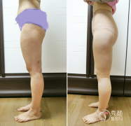 上海哪家整形医院吸脂好？上海吸脂医院医生分析。