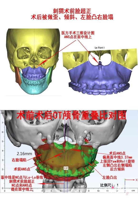 上海第九人民医院整复外科王旭东正颌案例分享。