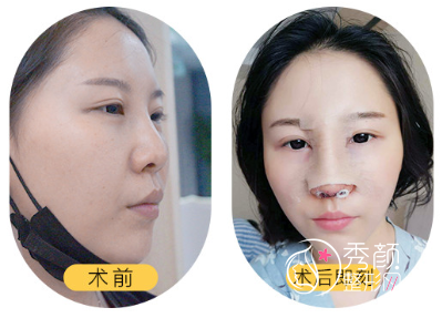 上海鼻修复哪个医生好，上海隆鼻医生测评|排名
