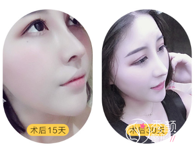 上海鼻修复哪个医生好，上海隆鼻医生测评|排名