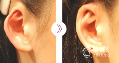 小耳朵整形哪家医院好，怎么选择，选择标准是什么？