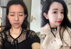 北京脂肪填充乔爱军、王沛森，冯斌怎么样，哪个好？性价比高？