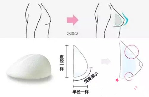假体隆胸水滴形和圆形哪个好看?隆胸水滴形和圆形对比果图
