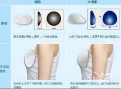 <b>假体隆胸水滴形和圆形哪个好看?隆胸水滴形和圆形对比果图</b>