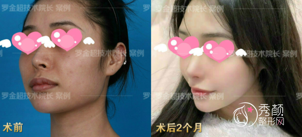 北京磨骨刘金超下颌角整形怎么样,有没有失败案例?