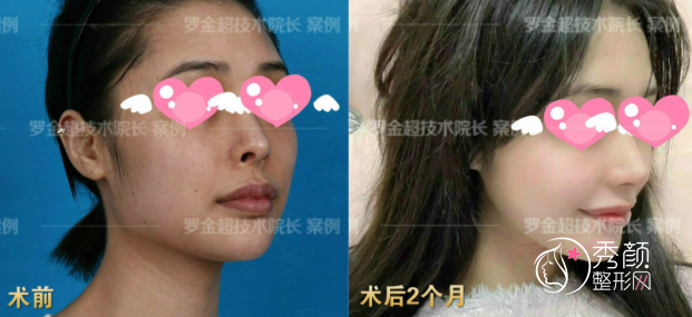 北京磨骨刘金超下颌角整形怎么样,有没有失败案例?