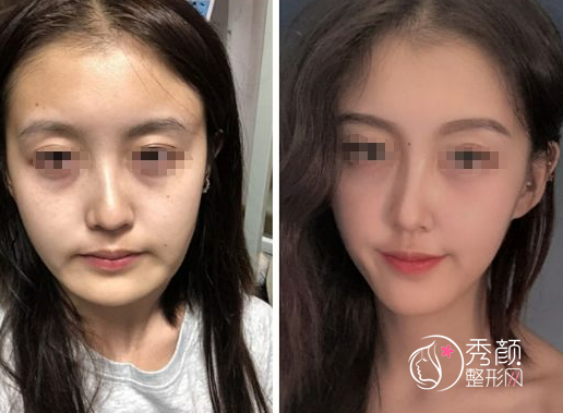 上海磨骨时光整形何晋龙和美联臣曹栋弼哪个好