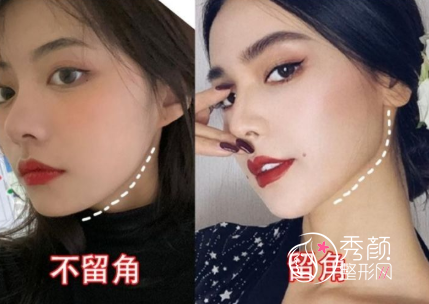 上海磨骨美联臣曹栋弼和首尔丽格朴兴植哪个好