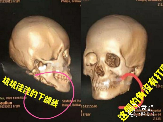 上海九院磨骨怎么样？有失败案例吗？