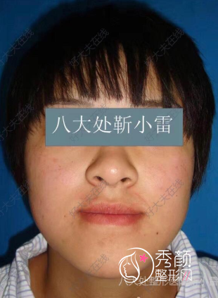 北京八大处靳小雷地包天术后5年案例