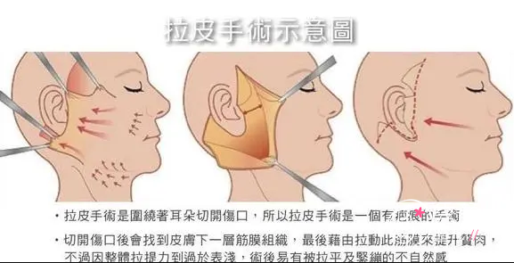 上海时光、艺星和薇琳哪个医院做拉皮手术好？