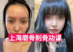 <b>上海磨骨一般需要多少钱？</b>