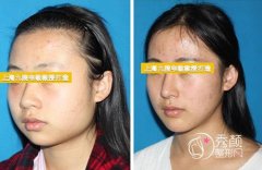 上海九院磨骨怎么样？要多少钱？