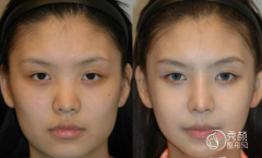 <b>上海做个磨骨手术需要多少钱？</b>