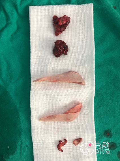 上海穆雄铮磨骨怎么样？大概需要多少钱？