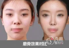 国内所有磨骨医生整理|国内磨骨医生合集