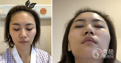 杭州颧骨内推500多天恢复记录，做的好不好你们来说说