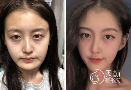 武汉磨骨哪个医生好,大概需要多少钱？