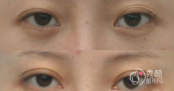 青岛哪个医生割双眼皮和双眼皮修复做的好？