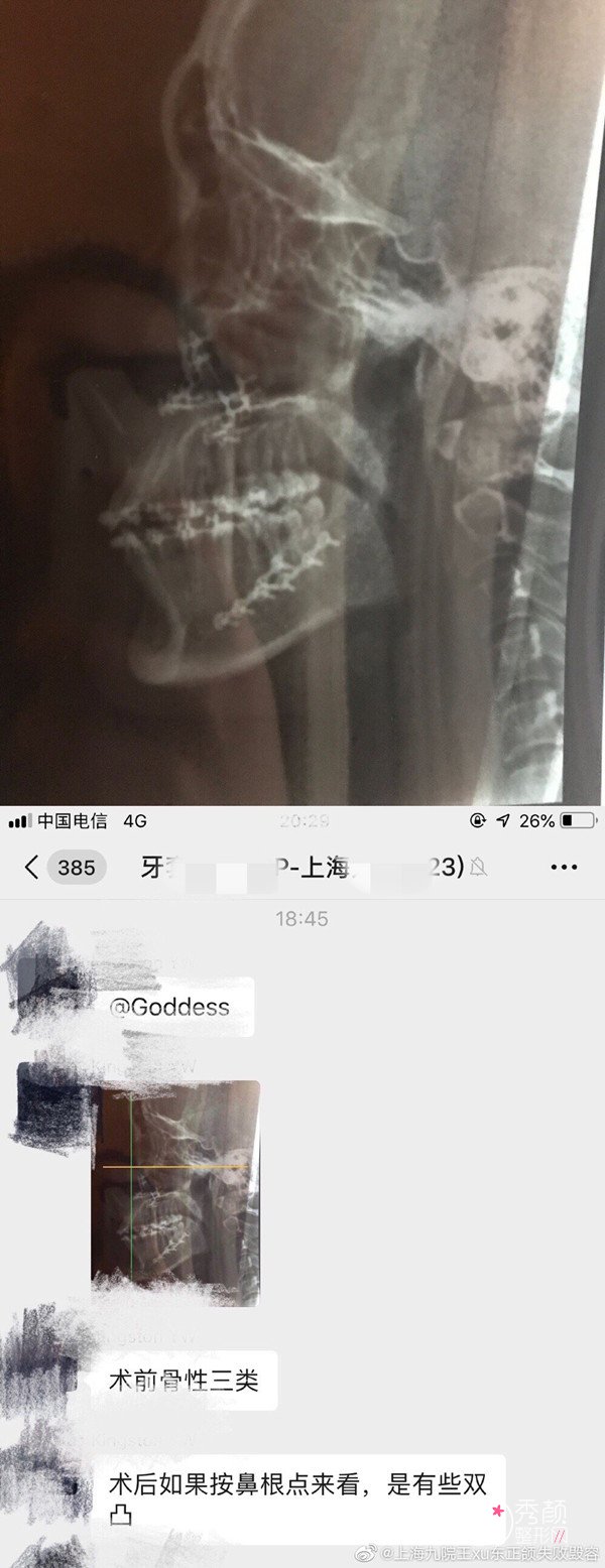 上海jy（公立医院）正颌手术失败,维权太难了！