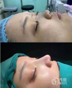 <b>上海九院隆鼻王健、王琛和王涛哪个好</b>