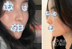 厦门隆鼻哪个医院医生好？陈运生、张宏、林清福等。